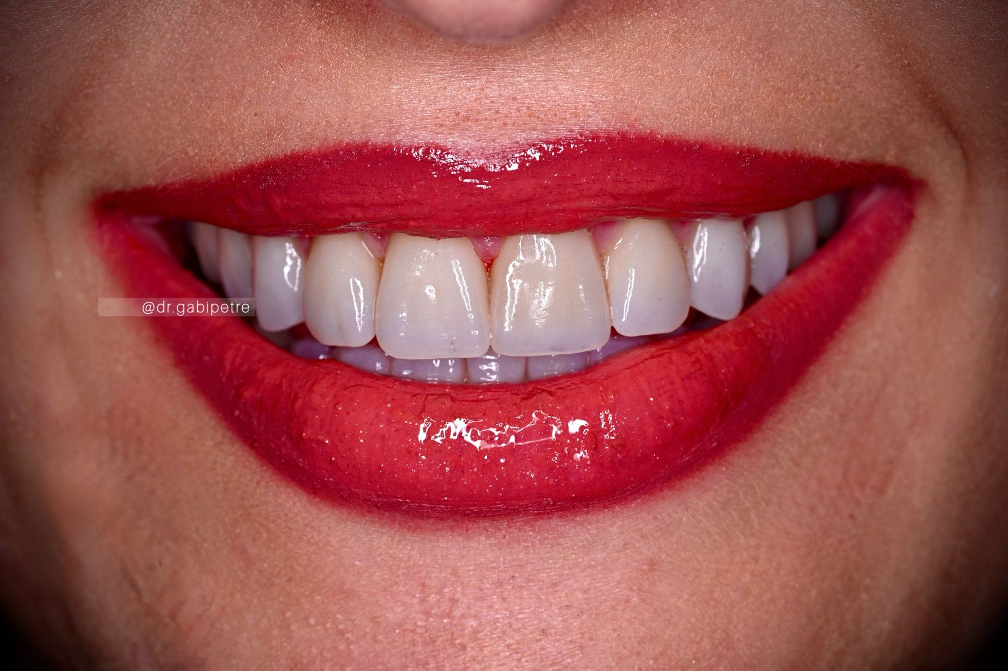 implant dentar slatina